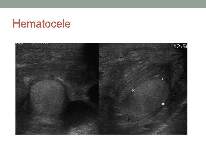 Hematocele Hematocele