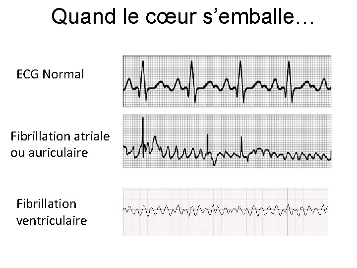 Quand le cœur s’emballe… ECG Normal Fibrillation atriale ou auriculaire Fibrillation ventriculaire 