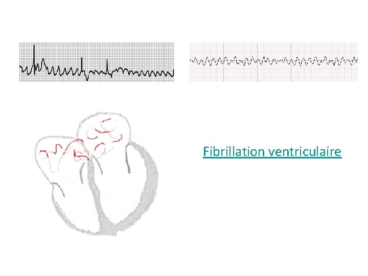 Fibrillation ventriculaire 
