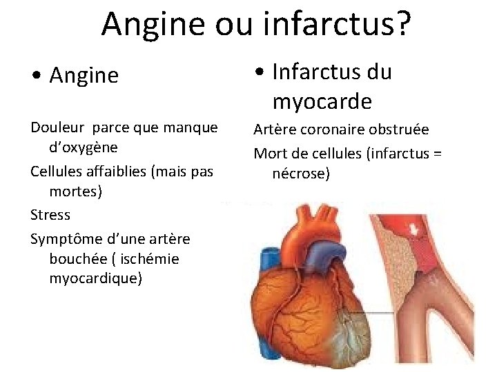 Angine ou infarctus? • Angine • Infarctus du myocarde Douleur parce que manque d’oxygène