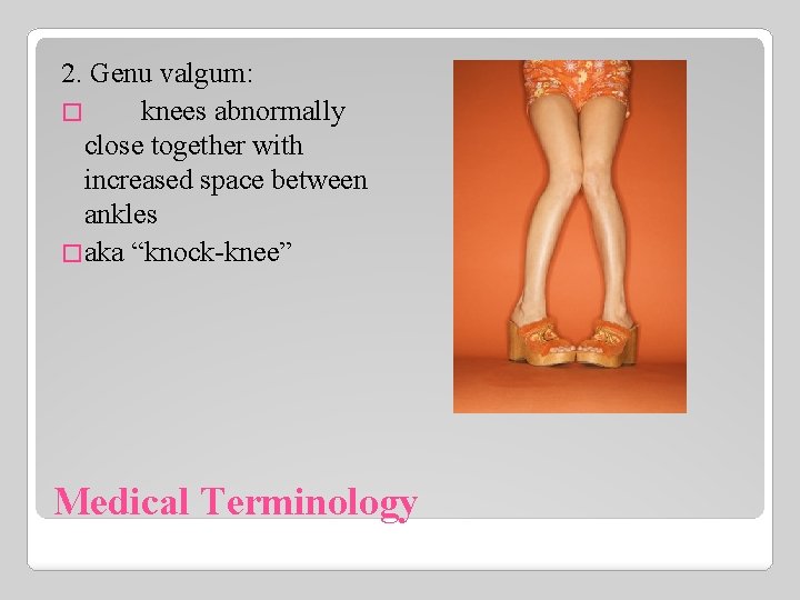 2. Genu valgum: � knees abnormally close together with increased space between ankles �aka