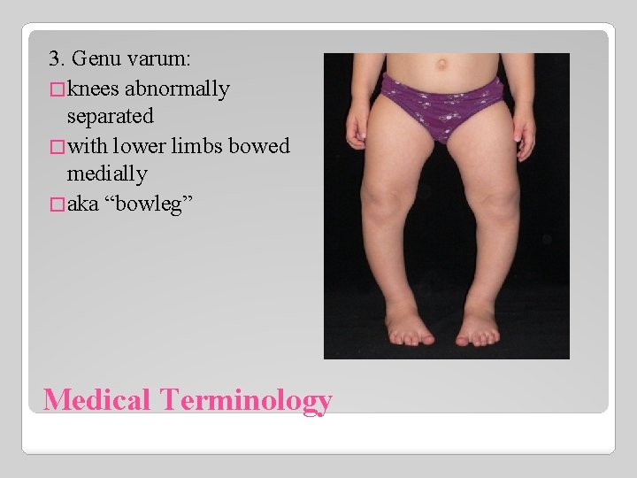 3. Genu varum: �knees abnormally separated �with lower limbs bowed medially �aka “bowleg” Medical