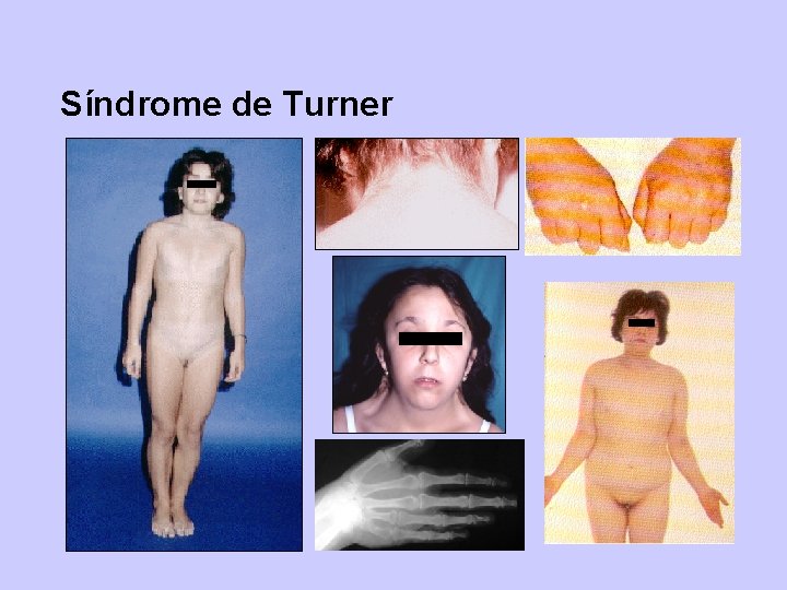 Síndrome de Turner 