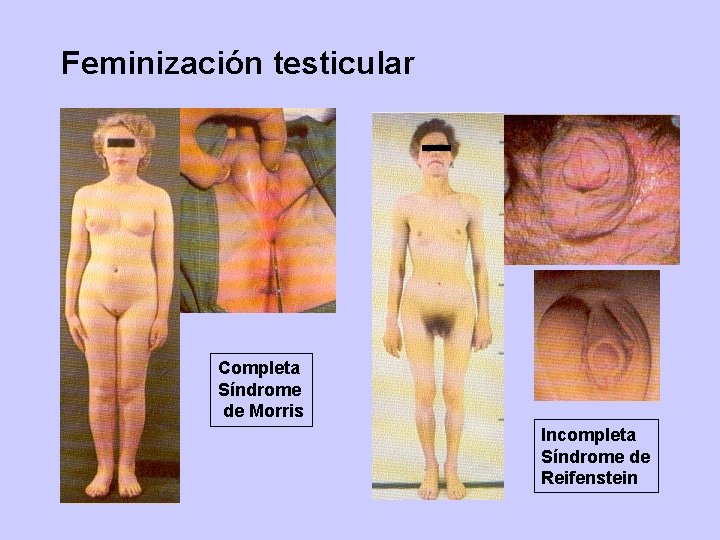 Feminización testicular Completa Síndrome de Morris Incompleta Síndrome de Reifenstein 