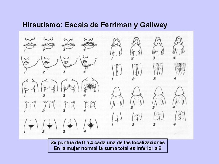 Hirsutismo: Escala de Ferriman y Gallwey Se puntúa de 0 a 4 cada una