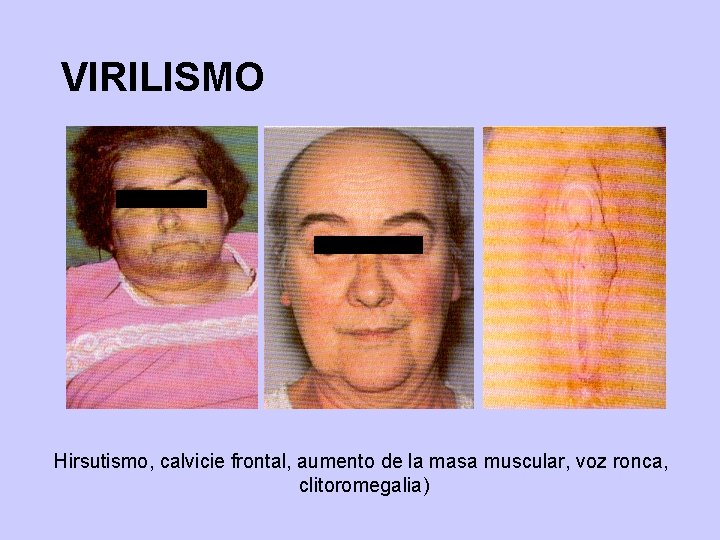 VIRILISMO Hirsutismo, calvicie frontal, aumento de la masa muscular, voz ronca, clitoromegalia) 