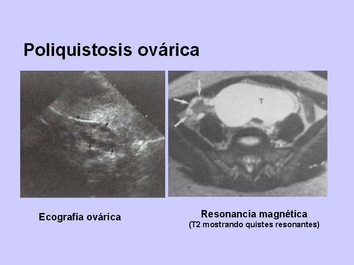 Poliquistosis ovárica Ecografía ovárica Resonancia magnética (T 2 mostrando quistes resonantes) 