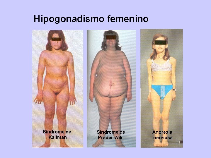 Hipogonadismo femenino Síndrome de Kallman Síndrome de Prader Wili Anorexia nerviosa 