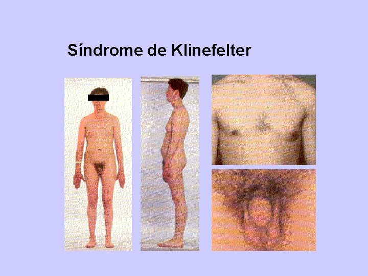Síndrome de Klinefelter 