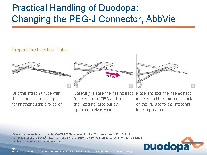Practical Handling of Duodopa: Changing the PEG-J Connector, Abb. Vie Prepare the Intestinal Tube