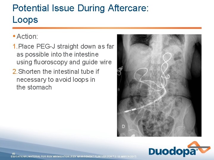 Potential Issue During Aftercare: Loops • Action: 1. Place PEG-J straight down as far