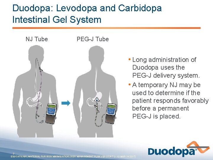 Duodopa: Levodopa and Carbidopa Intestinal Gel System NJ Tube PEG-J Tube • Long administration