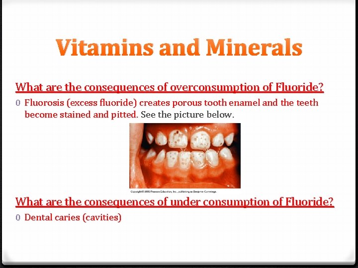 Vitamins and Minerals What are the consequences of overconsumption of Fluoride? 0 Fluorosis (excess