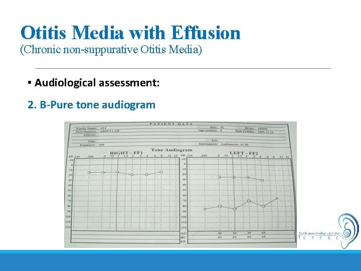 Otitis Media with Effusion (Chronic non-suppurative Otitis Media) • Audiological assessment: 2. B-Pure tone