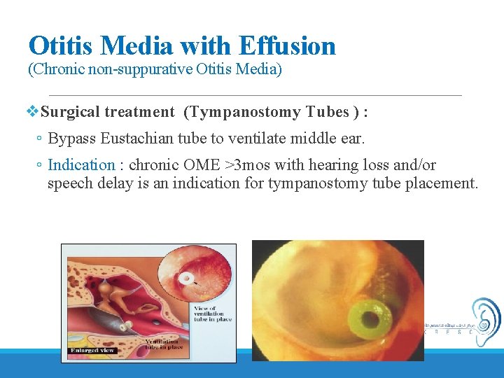 Otitis Media with Effusion (Chronic non-suppurative Otitis Media) v. Surgical treatment (Tympanostomy Tubes )