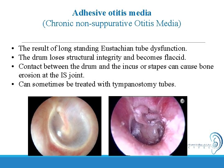 Adhesive otitis media (Chronic non-suppurative Otitis Media) • The result of long standing Eustachian