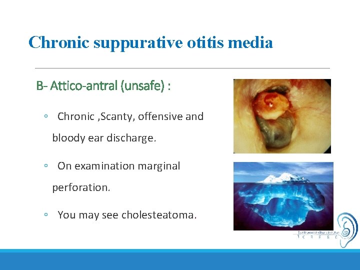 Chronic suppurative otitis media B- Attico-antral (unsafe) : ◦ Chronic , Scanty, offensive and