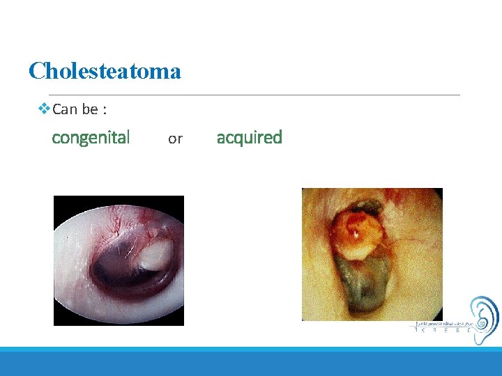 Cholesteatoma v. Can be : congenital or acquired 