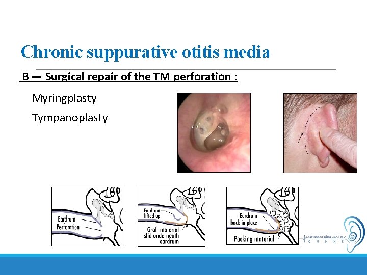 Chronic suppurative otitis media B — Surgical repair of the TM perforation : Myringplasty