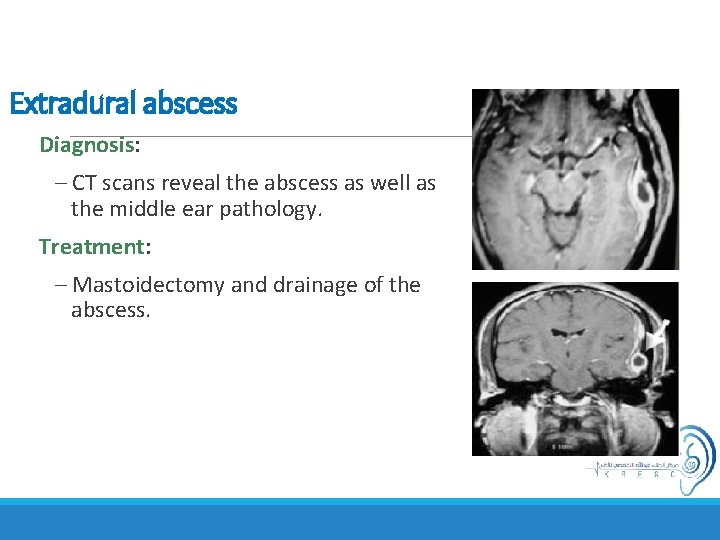 Extradural abscess Diagnosis: – CT scans reveal the abscess as well as the middle