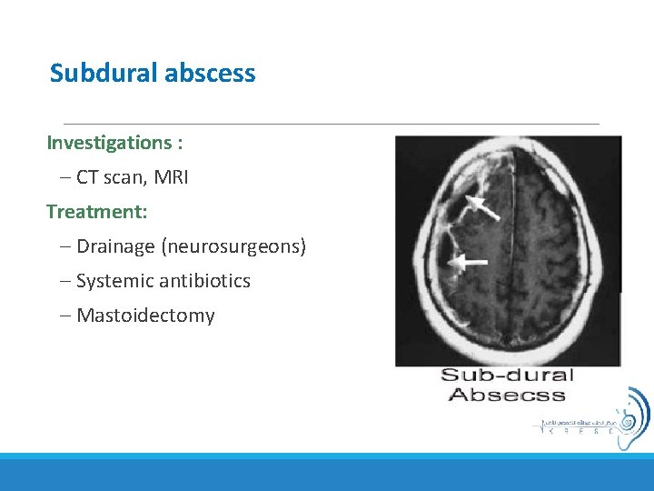 Subdural abscess Investigations : – CT scan, MRI Treatment: – Drainage (neurosurgeons) – Systemic