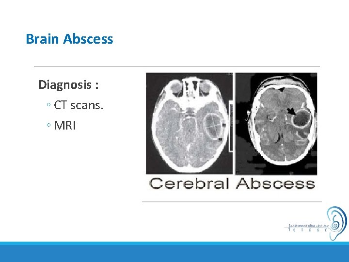 Brain Abscess Diagnosis : ◦ CT scans. ◦ MRI 