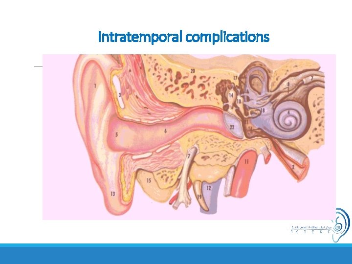 Intratemporal complications 