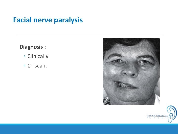 Facial nerve paralysis Diagnosis : ◦ Clinically ◦ CT scan. 