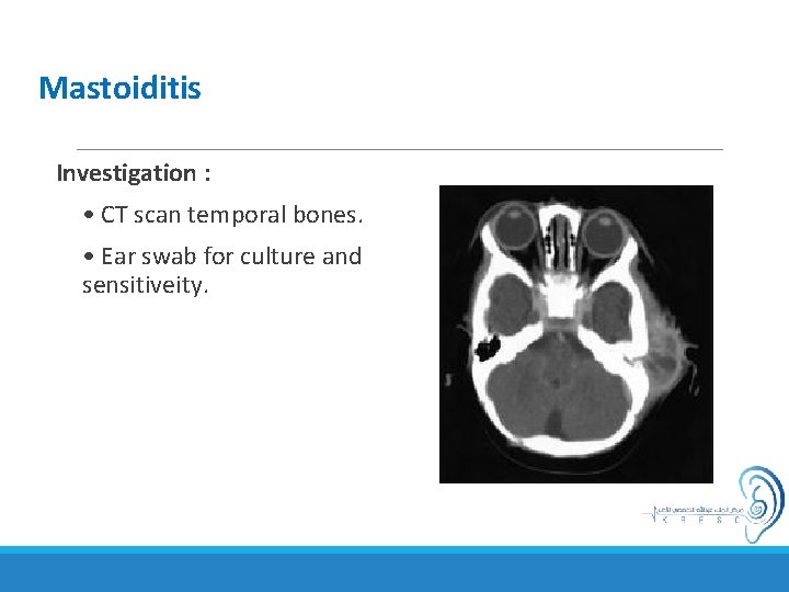 Mastoiditis Investigation : • CT scan temporal bones. • Ear swab for culture and