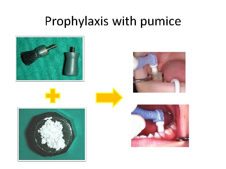 Prophylaxis with pumice 