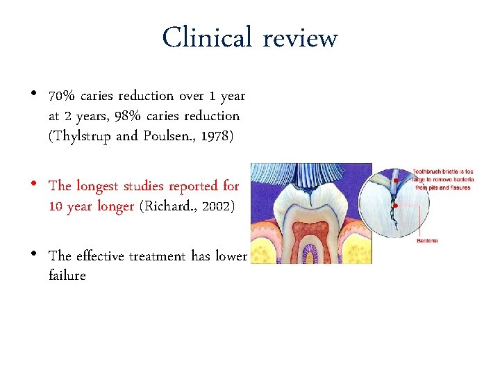 Clinical review • 70% caries reduction over 1 year at 2 years, 98% caries