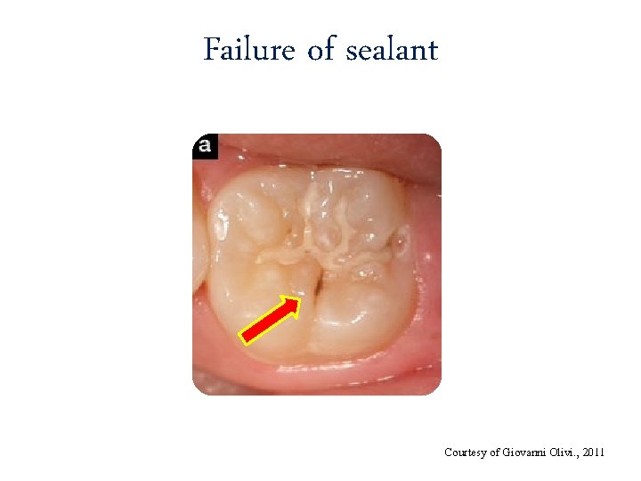 Failure of sealant Courtesy of Giovanni Olivi. , 2011 