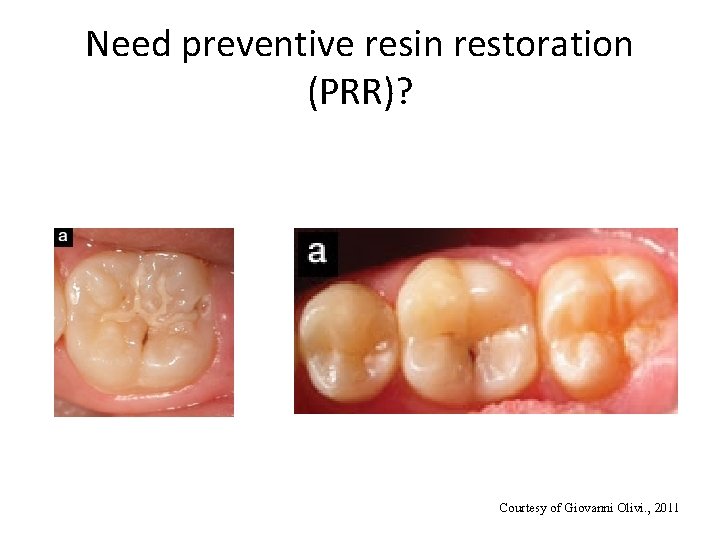 Need preventive resin restoration (PRR)? Courtesy of Giovanni Olivi. , 2011 