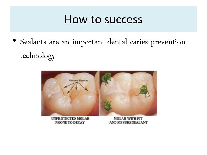 How to success • Sealants are an important dental caries prevention technology 