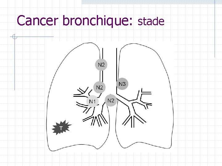Cancer bronchique: stade Cancer bronchique: stade