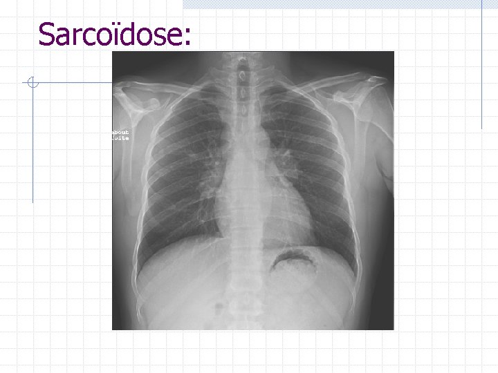 Sarcoïdose: Sarcoïdose: