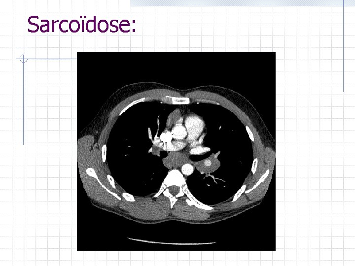 Sarcoïdose: Sarcoïdose: