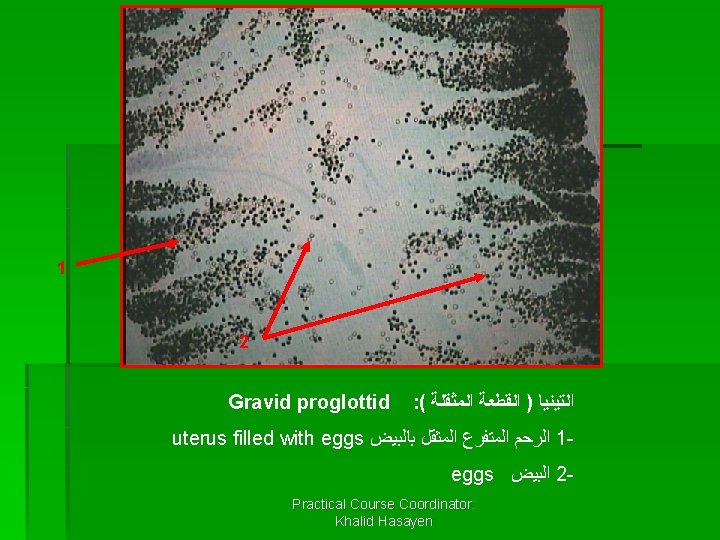 1 2 Gravid proglottid : ( ﺍﻟﺘﻴﻨﻴﺎ ) ﺍﻟﻘﻄﻌﺔ ﺍﻟﻤﺜﻘﻠﺔ uterus filled with eggs