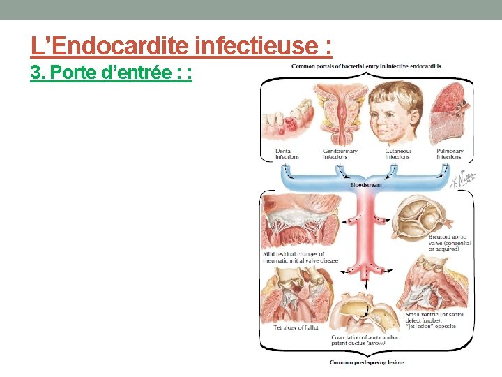 L’Endocardite infectieuse : 3. Porte d’entrée : : 