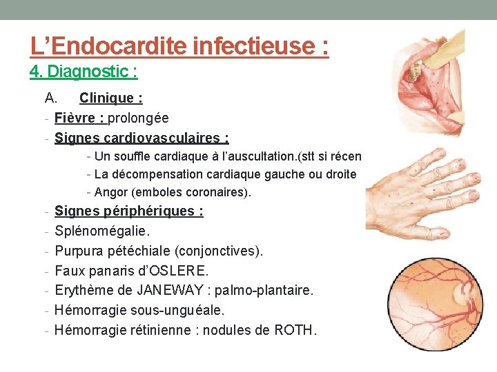 L’Endocardite infectieuse : 4. Diagnostic : A. Clinique : - Fièvre : prolongée -