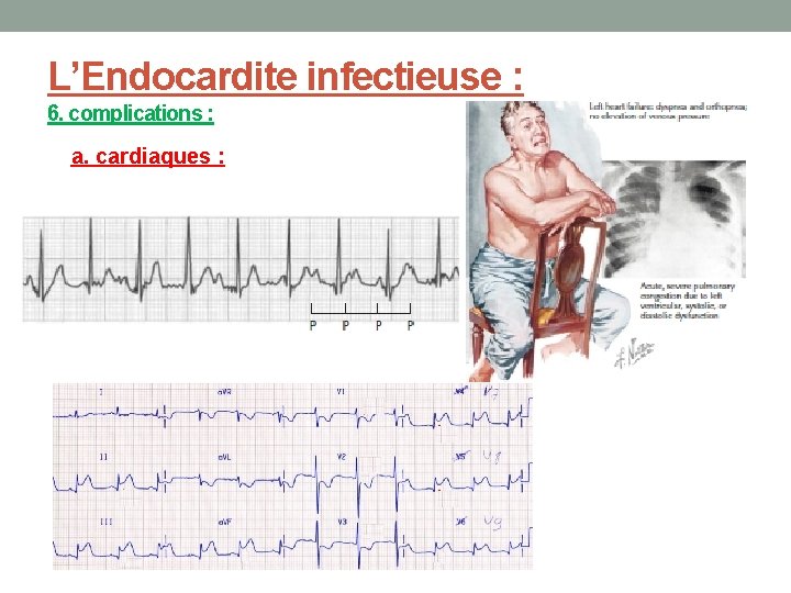 L’Endocardite infectieuse : 6. complications : a. cardiaques : 