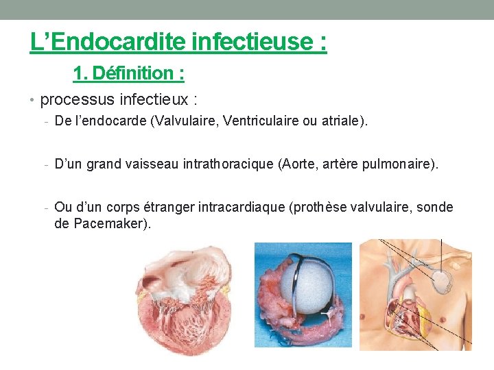 L’Endocardite infectieuse : 1. Définition : • processus infectieux : - De l’endocarde (Valvulaire,