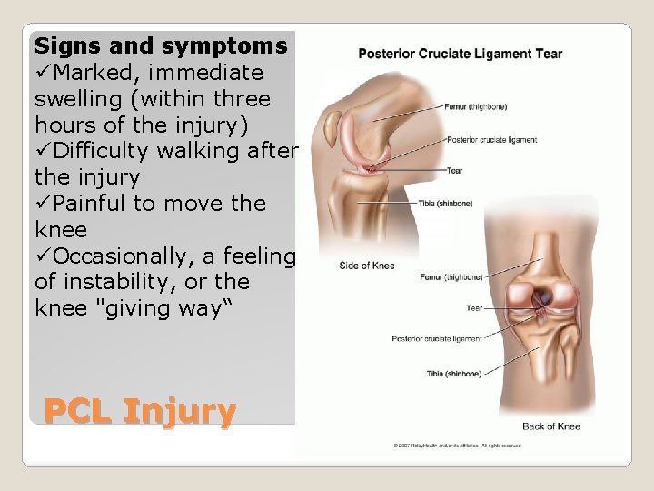 Signs and symptoms üMarked, immediate swelling (within three hours of the injury) üDifficulty walking