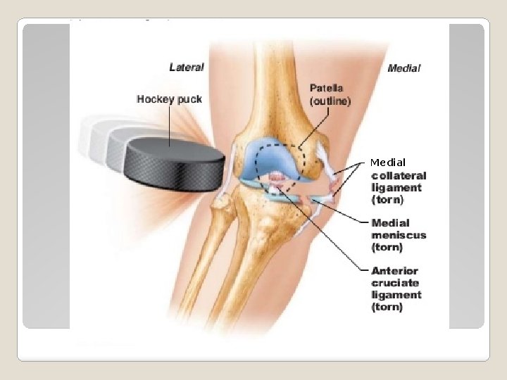 Medial 