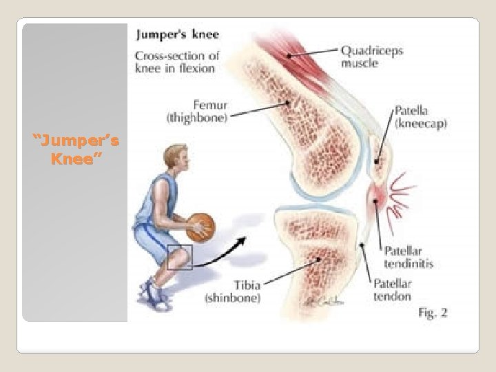 “Jumper’s Knee” 