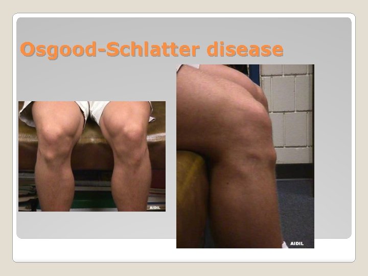 Osgood-Schlatter disease 