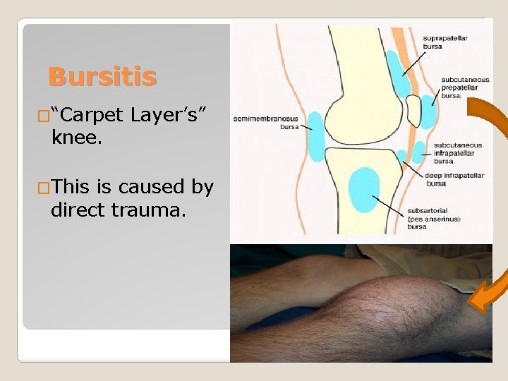 Bursitis �“Carpet knee. �This Layer’s” is caused by direct trauma. 