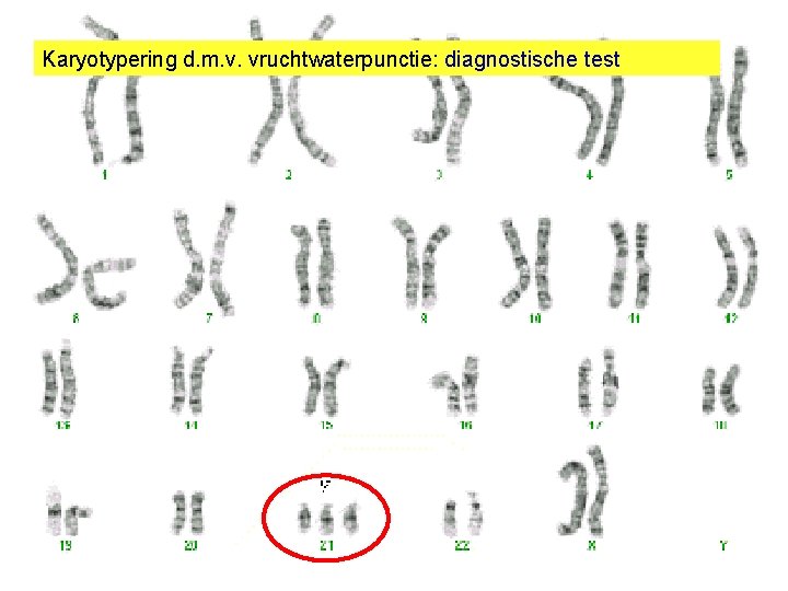Karyotypering d. m. v. vruchtwaterpunctie: diagnostische test GENETISCHE SCREENING wat is een genetische test?