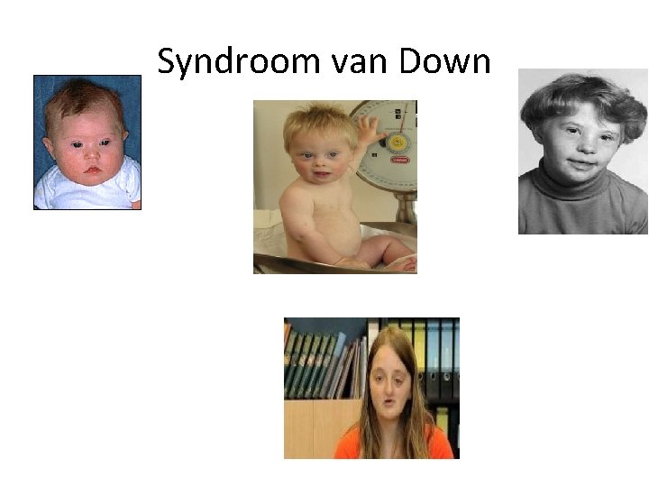 Syndroom van Down 