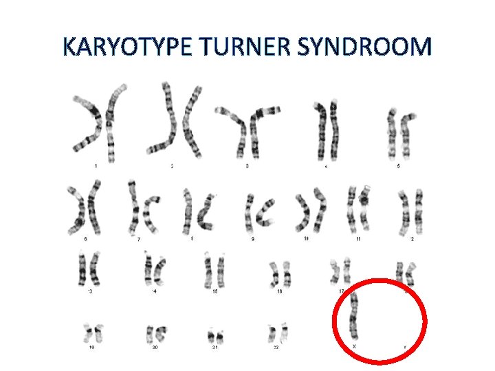 KARYOTYPE TURNER SYNDROOM 